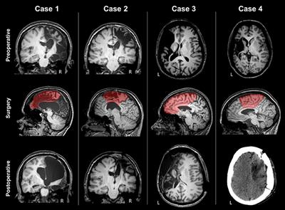Tracking the Re-organization of Motor Functions After Disconnective Surgery: A Longitudinal fMRI and DTI Study